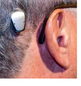 baha - aparelho auditivo de condução óssea